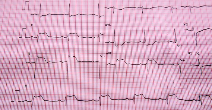 EKG - STEMI - znaci povišenja ST i infarkt srčanog mišića
