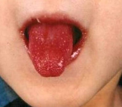 Kavasaki bolest - tipičan jezik maline