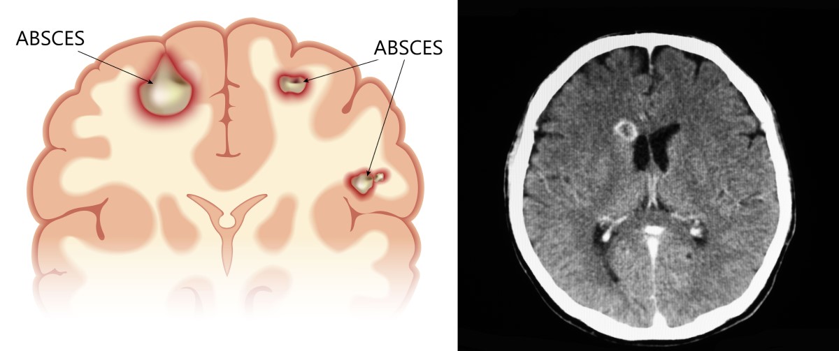 Anatomski prikaz i CT slika apscesa mozga