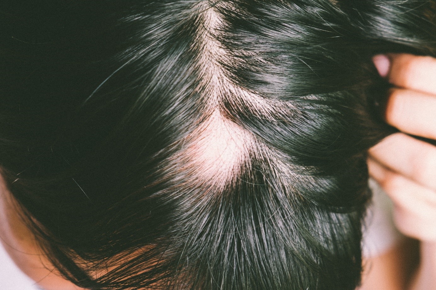 Alopécia, hlava, čierne vlasy, stav nadmernej straty vlasov