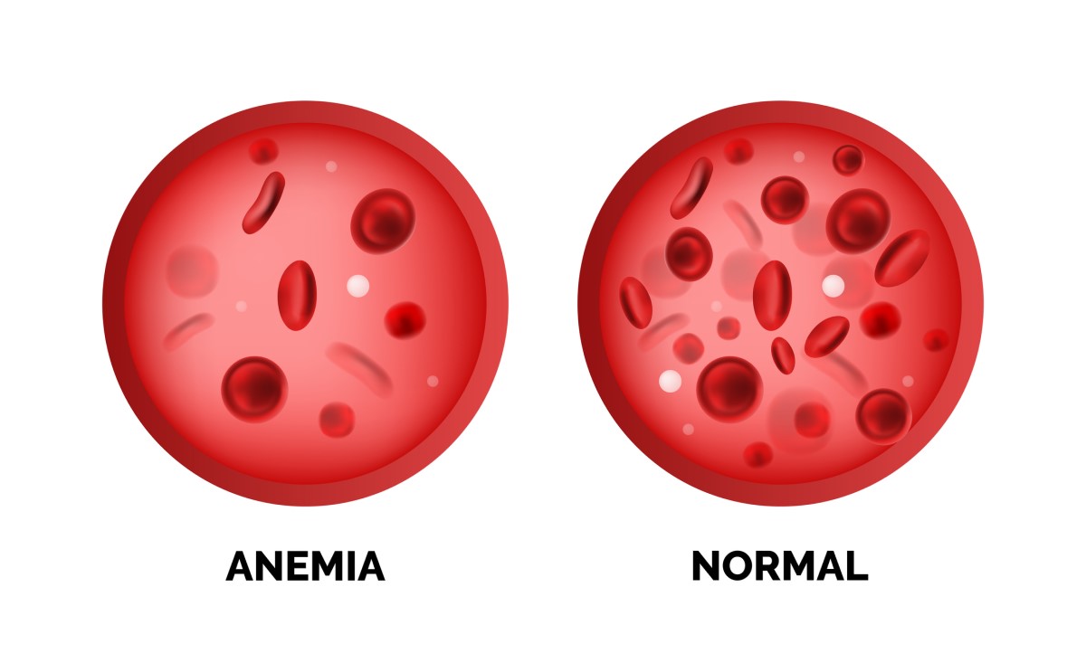Anémia a normála hladina krvných červených buniek