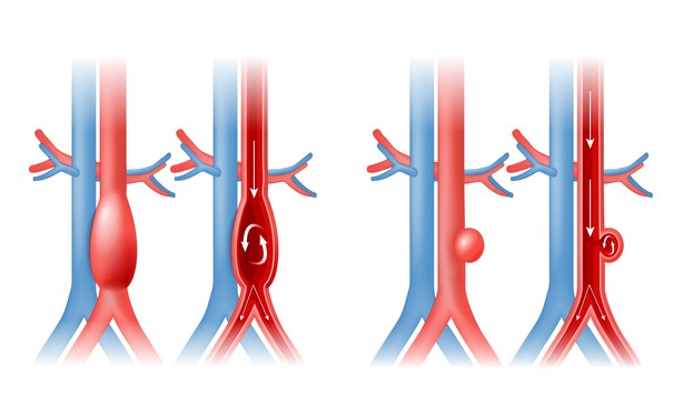 Aneurizma aorte i krvotok
