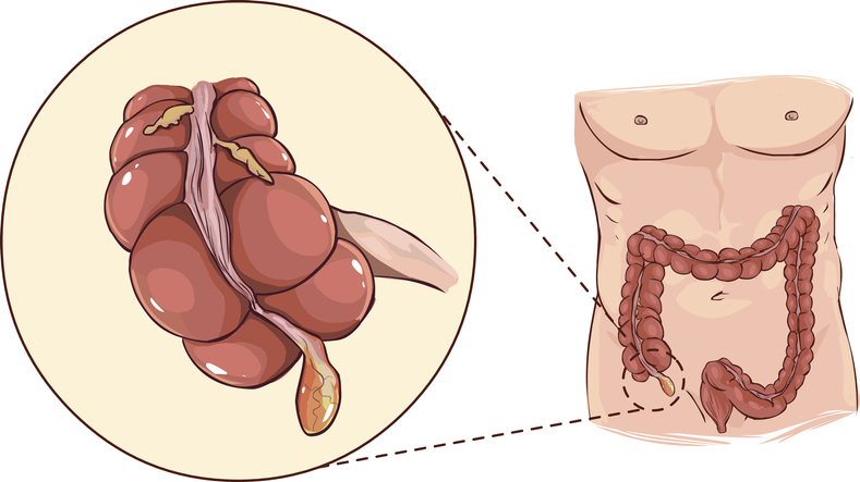 Appendix – slepo crevo kolokvijalno – anatomski prikaz na početku debelog creva.
