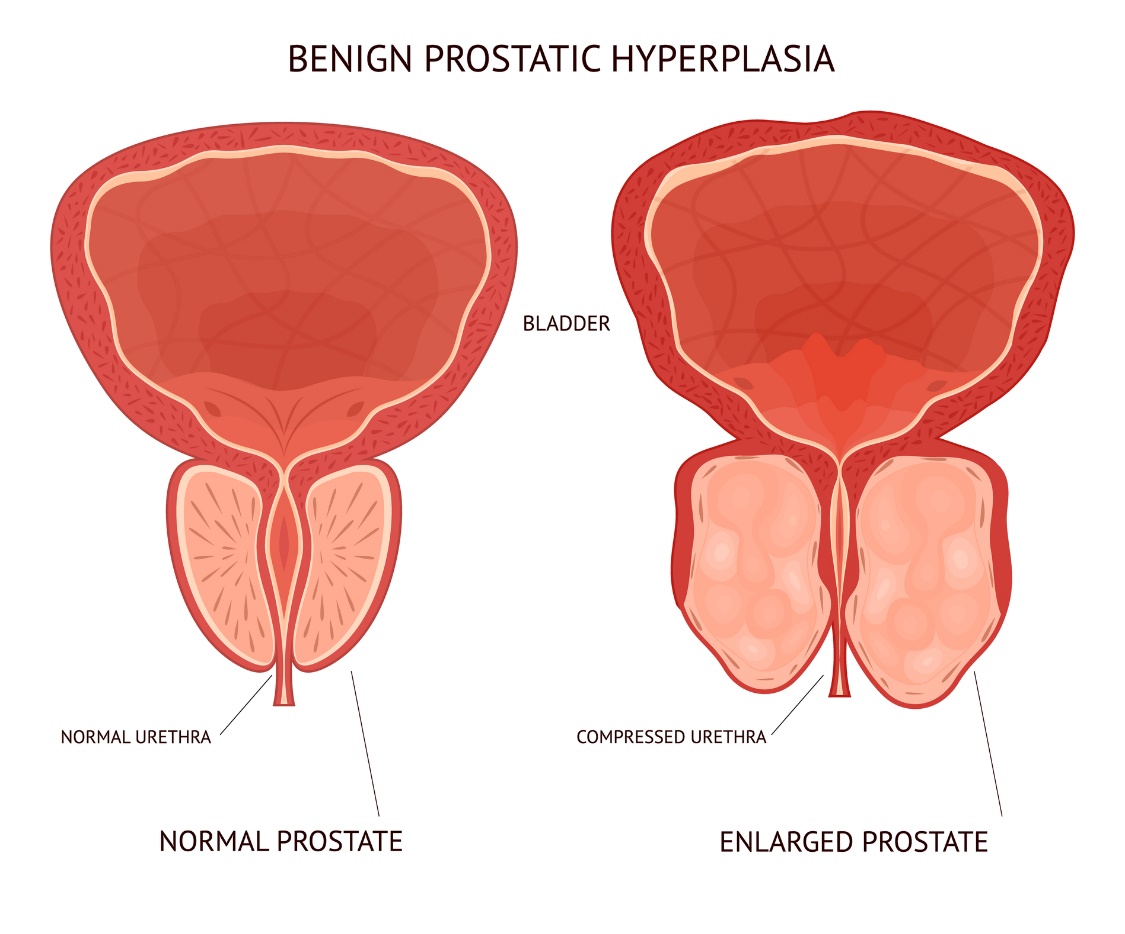 Benígna (nezhubná) hyperplázia prostaty