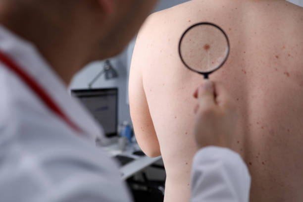 Dermatoskopia – vyšetrenie kožných útvarov