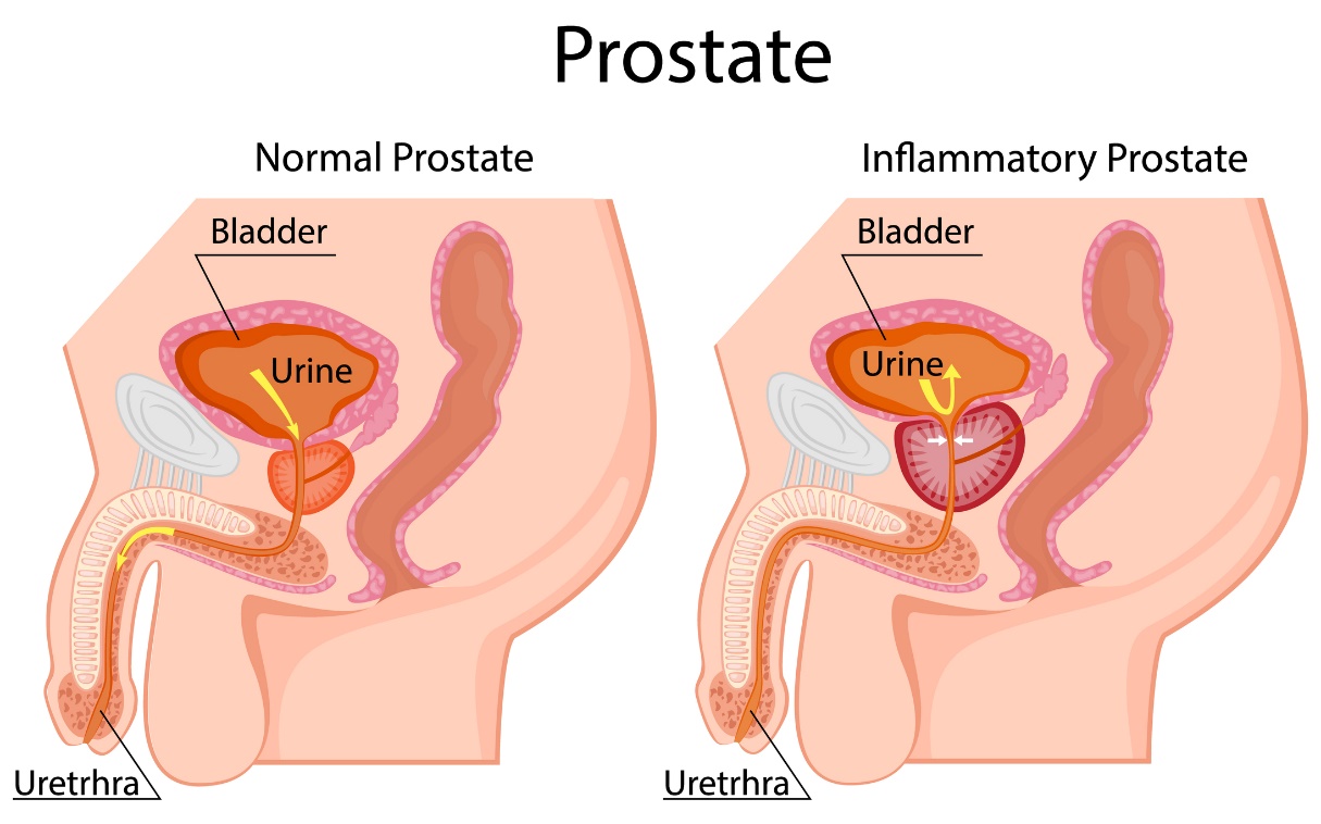 Vľavo: fyziologická prostata. Vpravo: zväčšená prostata. Lokalizovaná pod močovým mechúrom. Bladder (močový mechúr), urine (moč), urethra (močová trubica)