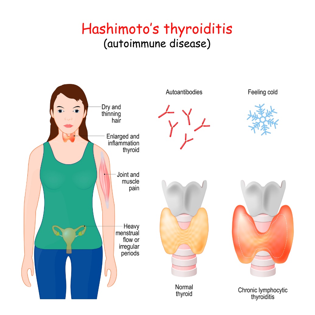 Hashimotova tyroiditída a klinické príznaky