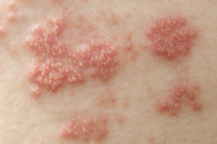 Mehurići sa herpes zoster na koži, ispunjeni tečnošću koja sadrži virus