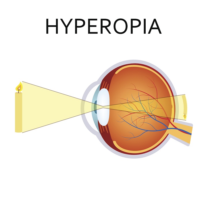 Hypemetropija