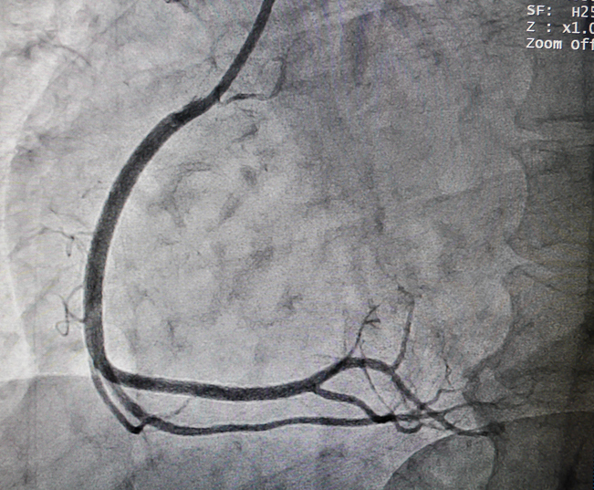 Koronarna angiografija - koronarna arterija, odnosno kardiovaskularni sistem