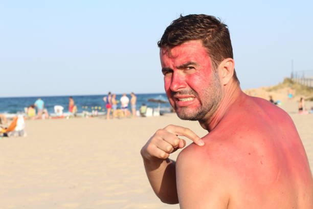 Koža spálená od slnka je predispozíciou vzniku kožných nádorov