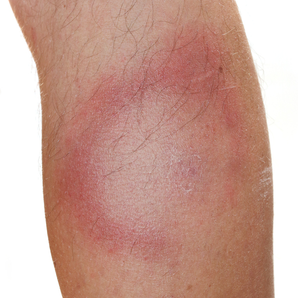 Tipičan simptom lajmske bolesti, odnosno migrirajući eritem, crvenilo kože, sa bledim centrom