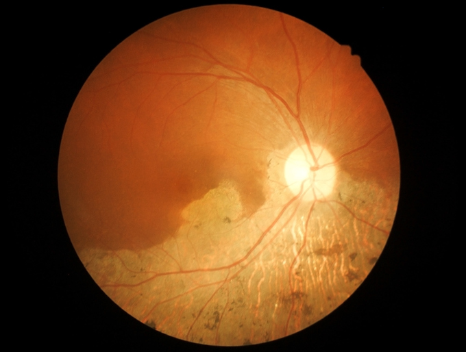 Makularna degeneracija tokom oftalmološkog pregleda