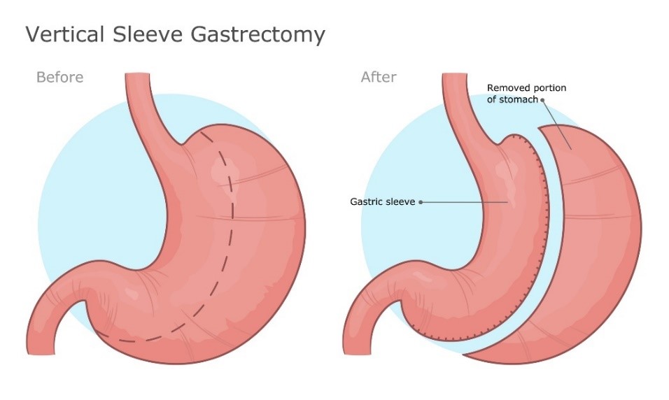 Vertikálny typ operačného zákroku gastroektómie