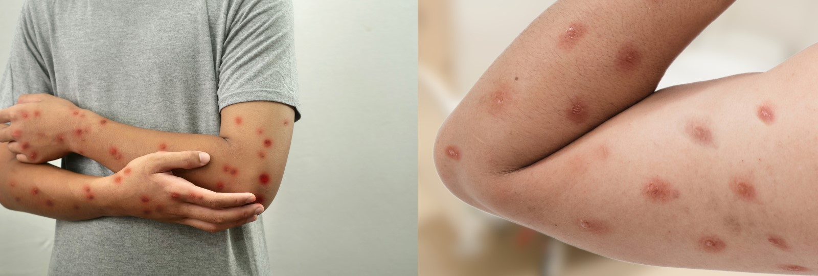 Početné vyrážky. Zdroj foto: Shutterstock Dva obrázky mužov, kde majú vyrážky po mpox už v relatívne dobrom stave v štádiu hojenia