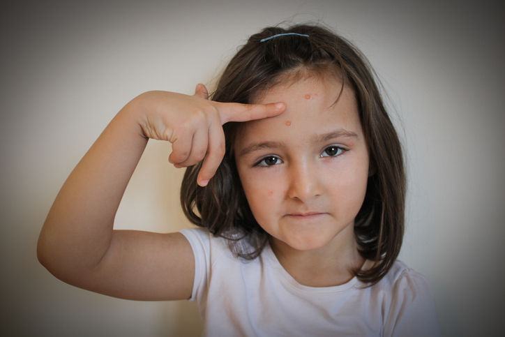 Virus Varicella zoster - devojka sa osipom na licu