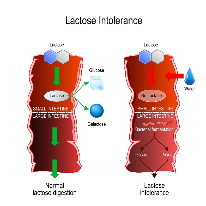 Porovnanie fyziologického trávenia a laktózovej intolerancie