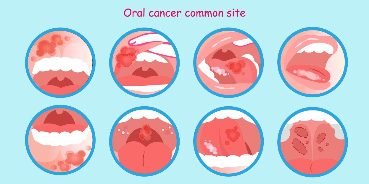 Rakovina ústnej dutiny a miesta výskytu vzniku nádoru - model