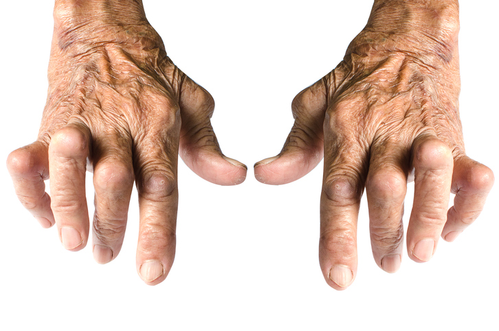 Tipični deformiteti šake kod reumatoidnog artritisa