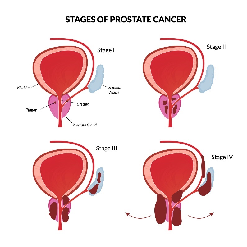 4 osnovne faze raka prostate