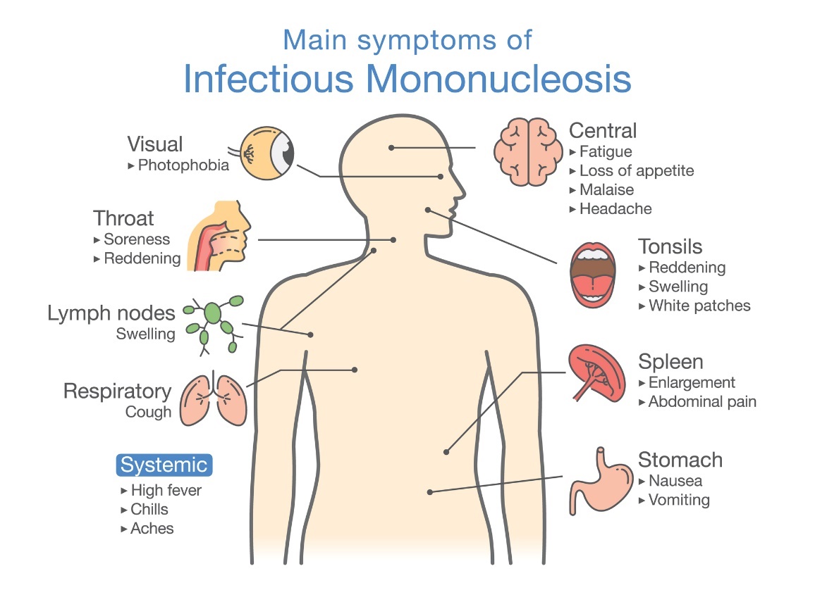 Simptomi infektivne mononukleoze