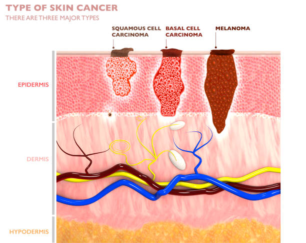 Typy kožných nádorov, ich prerastanie do kože – spinocelulárny karcinóm, bazaliom a melanóm