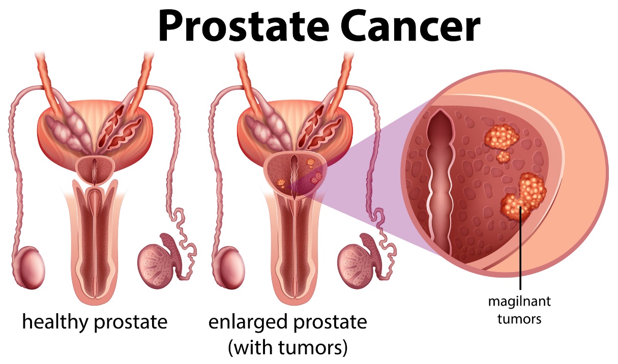 Karcinom prostate. Zdrava prostata i uvećana prostata sa tumorom.