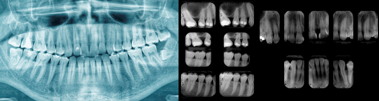 Rendgen snimak zuba, koji će pokazati stanje zuba, karijes i plombe.