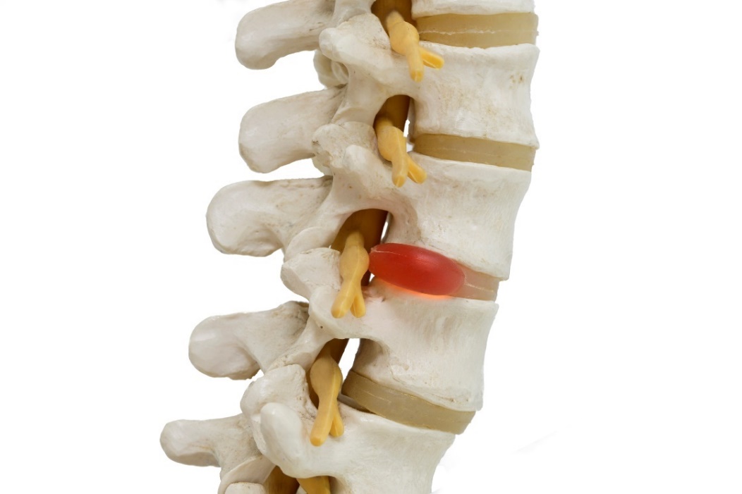 Útlak nervu herniou disku je jednou z možných príčin bolesti chrbtice. Zdroj foto: Getty Images Anatomické znázornenie 3D model chrbtice, medzistavcových platničiek a hernie disku s útlakom nervu