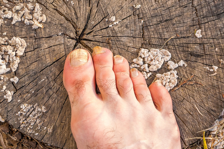 Nechtová mykóza je nepríjemné a neestetické ochorenie spôsobujúce deformity nechtov. Foto: Thinkstock noha s pleňou na nechtoch položená na pni stromu