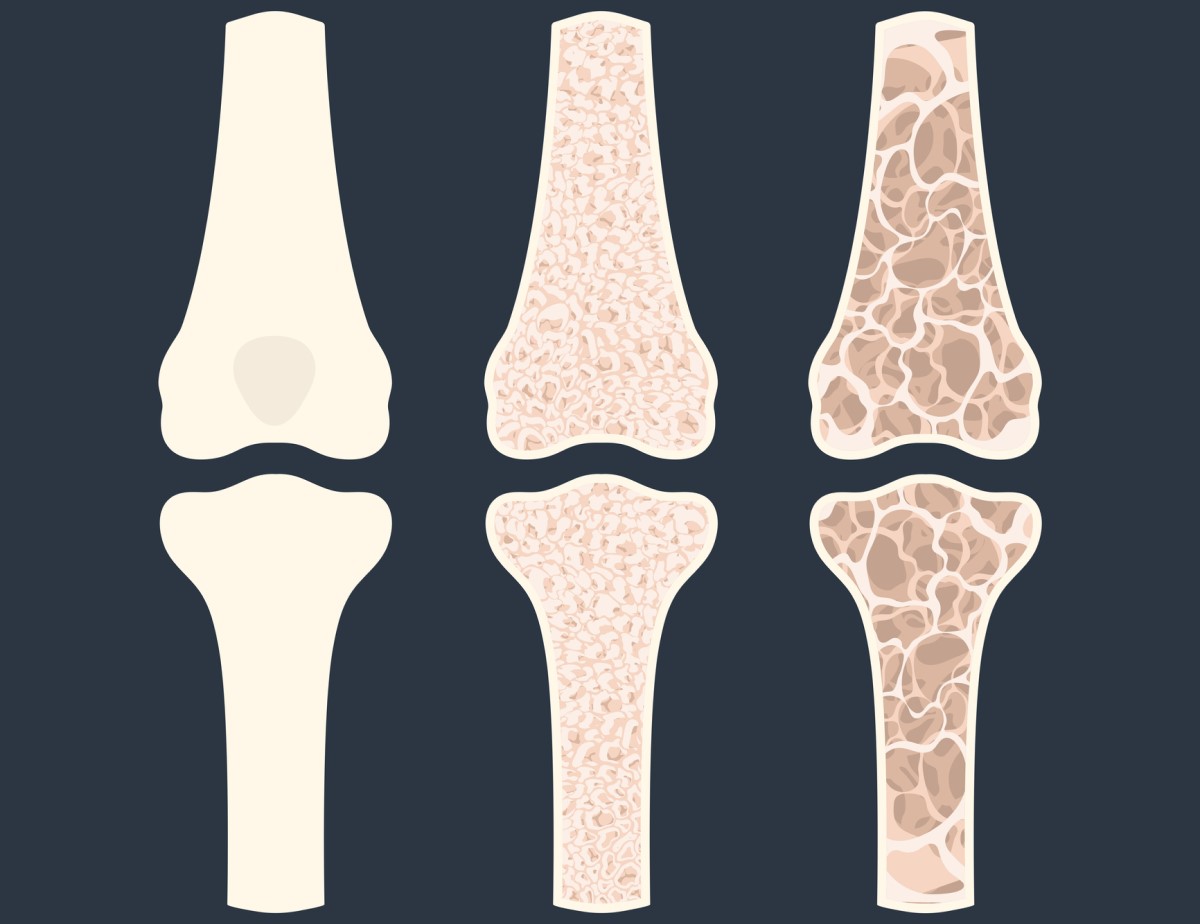 Najzávažnejším následkom hypokalciémie je vznik osteopénie a osteoporózy, ktoré sa prejavujú výrazným úbytkom kostnej hmoty. Zdroj foto: Getty images Animácia troch kostí, ktorá znázorňuje osteoporózu - rednutie kostí