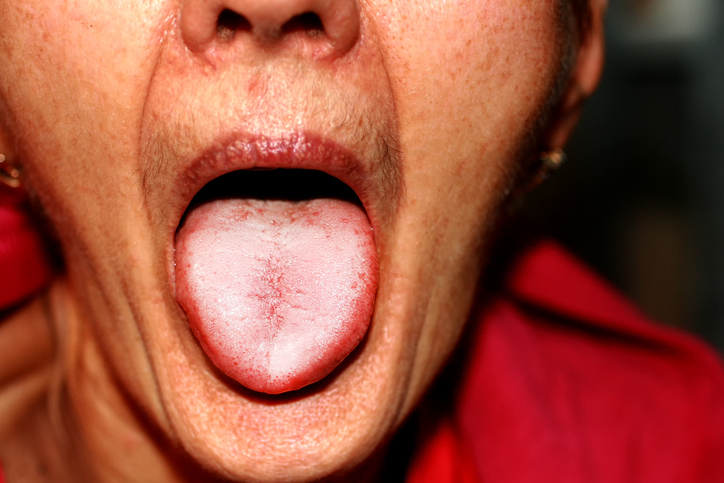 Pleseň na koži a slizniciach má väčšie množstvo ľudí ako by sa mohlo zdať. Foto: Thinkstock žena v červenom tričku vyplazuje jazyk postihnutý plesňou