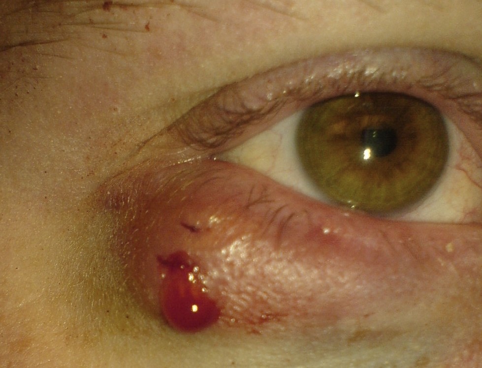 Halacion, tj. kvržica koja krvari nakon punkcije, za smanjenje pritiska, kapak zahvaćen upalom, desno oko