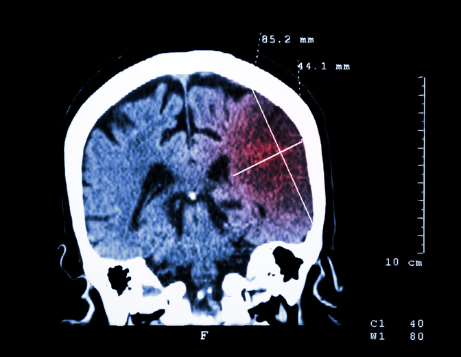 Oštećenje mozga vidljivo na CT skeniranju