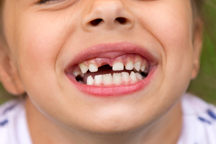 Dete ima mlečni zub, mlečni zub, ispao prvi zub, osmeh