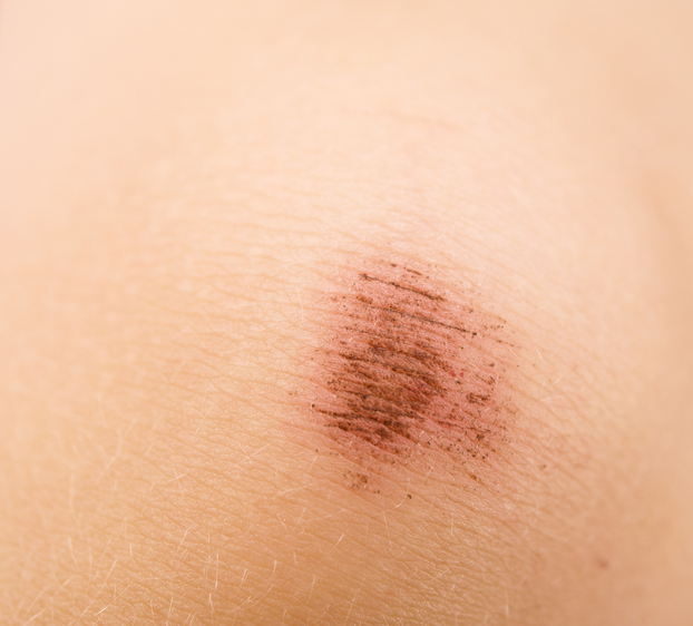 Abrazija na koži takođe znači bol na koži