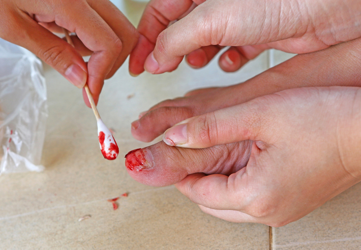 Oštećenje noktiju usled nezgode, krvarenja, tretman pamučnim štapićem
