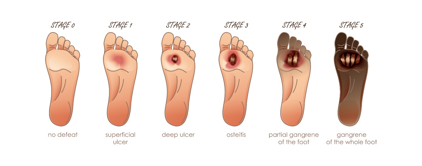 Ulkusna bolest nogu i njene faze