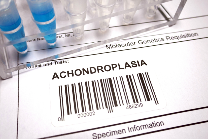 Ahondroplazija: Koji su uzroci, simptomi urođenog poremećaja kostiju?