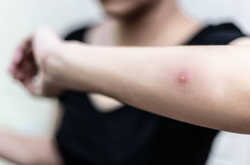 Apsces kože: šta je to, koji su uzroci i simptomi infekcije kože?