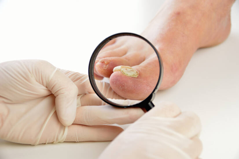 Mikoza noktiju, gljivice na stopalima i noktima: manifestacije i uklanjanje