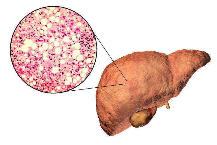 Steatoza jetre: Šta je to, zašto nastaje i kako se manifestuje? Kako lečiti jetru?
