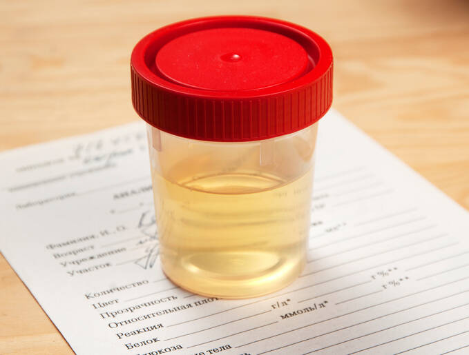 Šećer u urinu: Šta signalizira povišen šećer i koje vrednosti su normalne?
