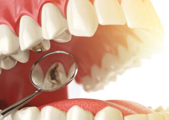 Zubni karijes: Zašto nastaje i kako se manifestuje? (+ kako izgleda)