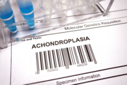 Ahondroplazija: Koji su uzroci, simptomi urođenog poremećaja kostiju?