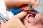 Paradentoza: Zašto nastaje i kako zaustaviti klimanje zuba i ojačati ih