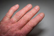 Psorijatični artritis: Uzroci i manifestacije psorijaze sa artritisom