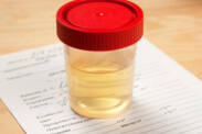 Šećer u urinu: Šta signalizira povišen šećer i koje vrednosti su normalne?