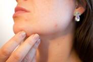 Osip na koži: Šta uzrokuje upaljen crveni osip i osip koji svrbi?